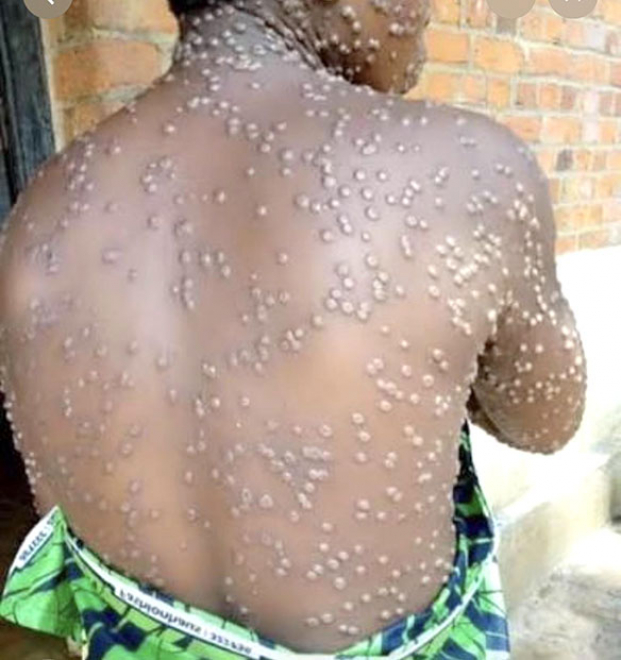 Variole du singe -&nbsp;Cinq cas confirm&eacute;s &agrave; Mahajanga, les gestes barri&egrave;res encourag&eacute;s!