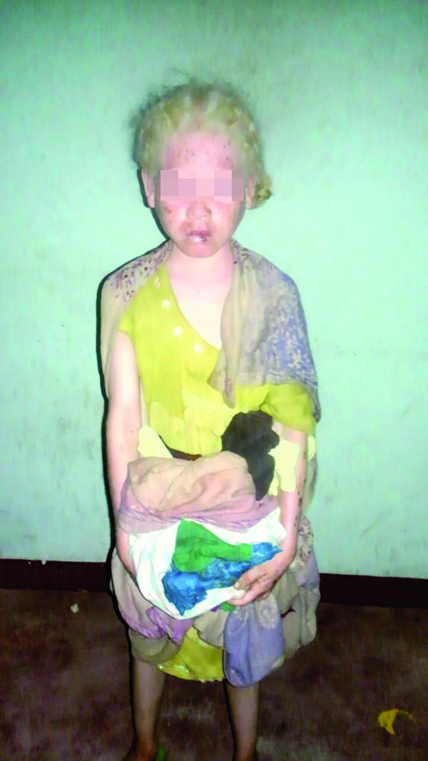 Vol d’organes liés aux superstitions - Le calvaire des albinos continue