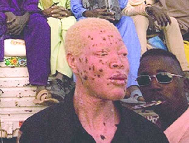 Albinos en Afrique - Victimes de crimes rituels ?