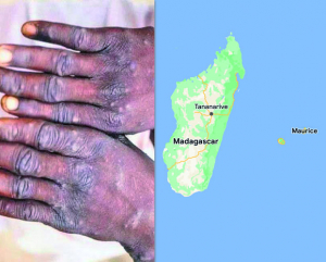 Maladie infectieuse - La variole du singe touche l’océan Indien