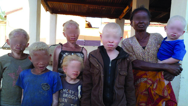 Enlèvements, assassinat et vol d’organes - Quid de la protection des personnes albinos du pays ?