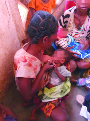 Malnutrition aigüe sévère et modérée - Hausse alarmante des cas à Betioky Sud